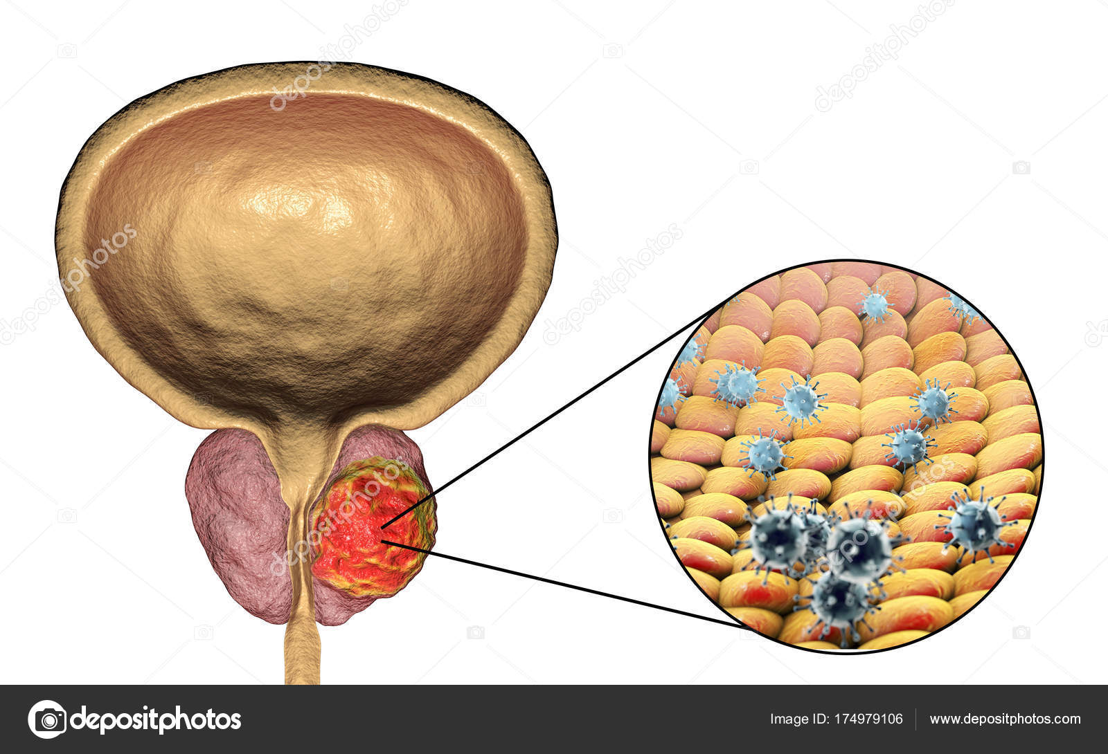 prostatitis vírusok