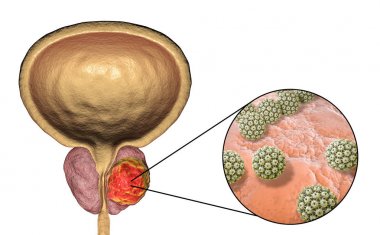 Prostat kanserinin viral ethiology için kavramsal görüntü