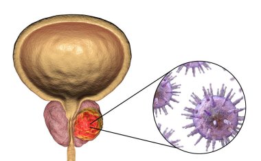 Prostat kanserinin viral ethiology için kavramsal görüntü
