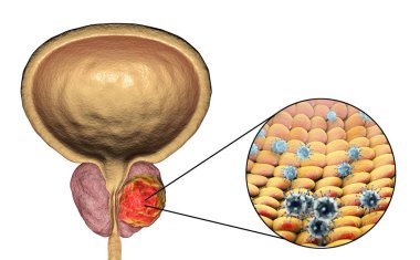 Prostat kanserinin viral ethiology için kavramsal görüntü