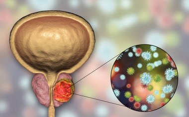 Prostat kanserinin viral ethiology için kavramsal görüntü