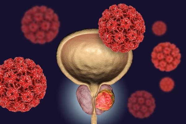 前列腺癌病毒 ethiology 的概念性图像 — 图库照片