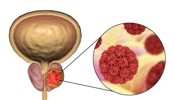 Begreppsmässiga image för viral etiologi av prostatacancer — Stockfoto