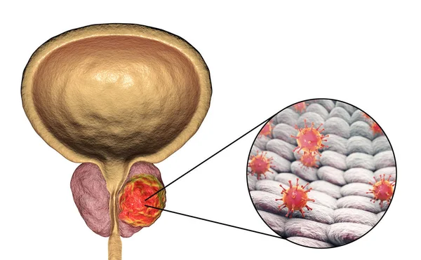 前列腺癌病毒 ethiology 的概念性图像 — 图库照片