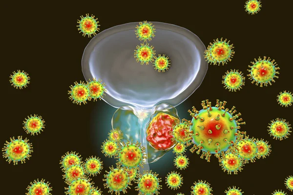 Концептуальный образ вирусной этиологии рака предстательной железы — стоковое фото