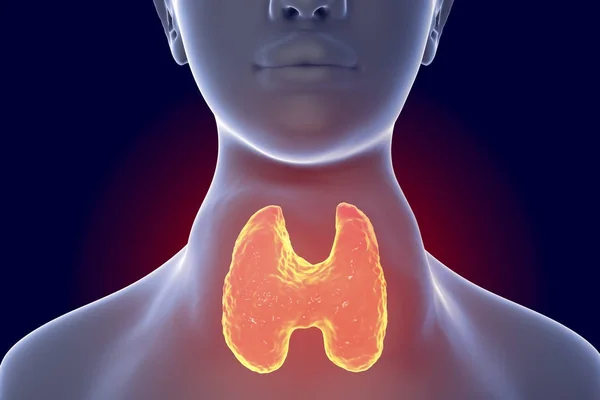 Toxic diffuse goiter, hyperthyroidism — Stock Photo, Image