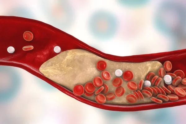 Cholesterol plak v tepně — Stock fotografie