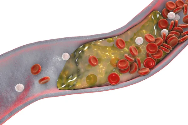 stock image Cholesterol plaque in artery