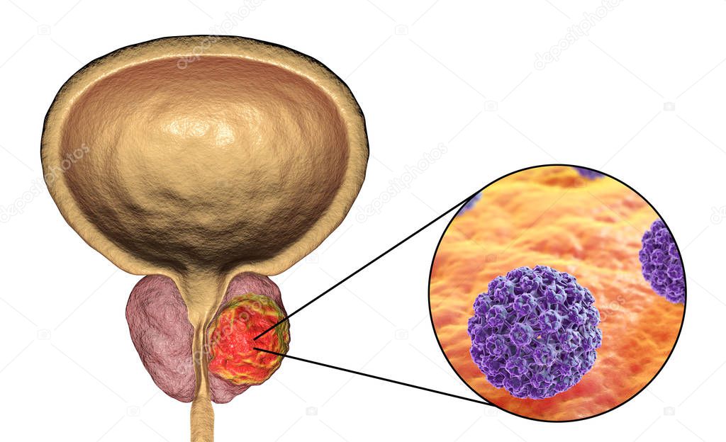 Conceptual image for viral ethiology of prostate cancer