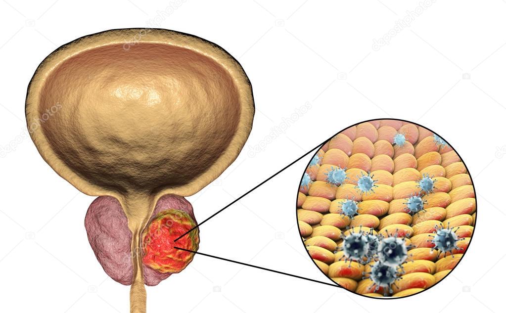 Conceptual image for viral ethiology of prostate cancer