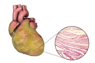 Obese heart, illustration clipart