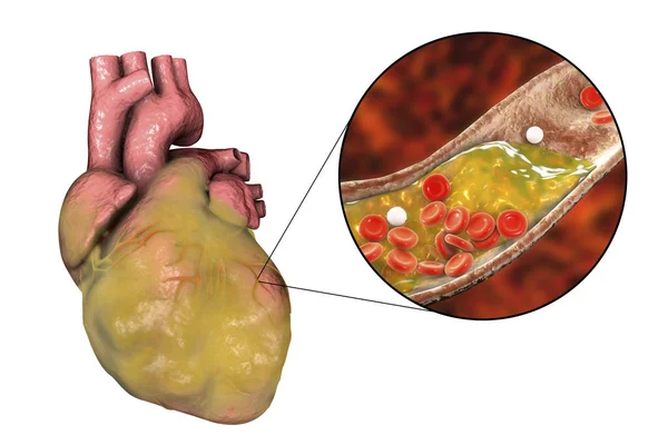 Obez kalp, illüstrasyon — Stok fotoğraf