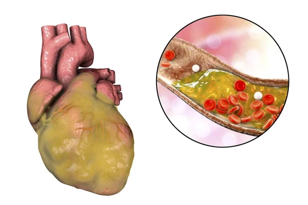 Obese heart, illustration — Stock Photo, Image