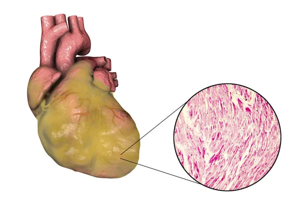 Παχύσαρκα καρδιά, εικονογράφηση — Φωτογραφία Αρχείου
