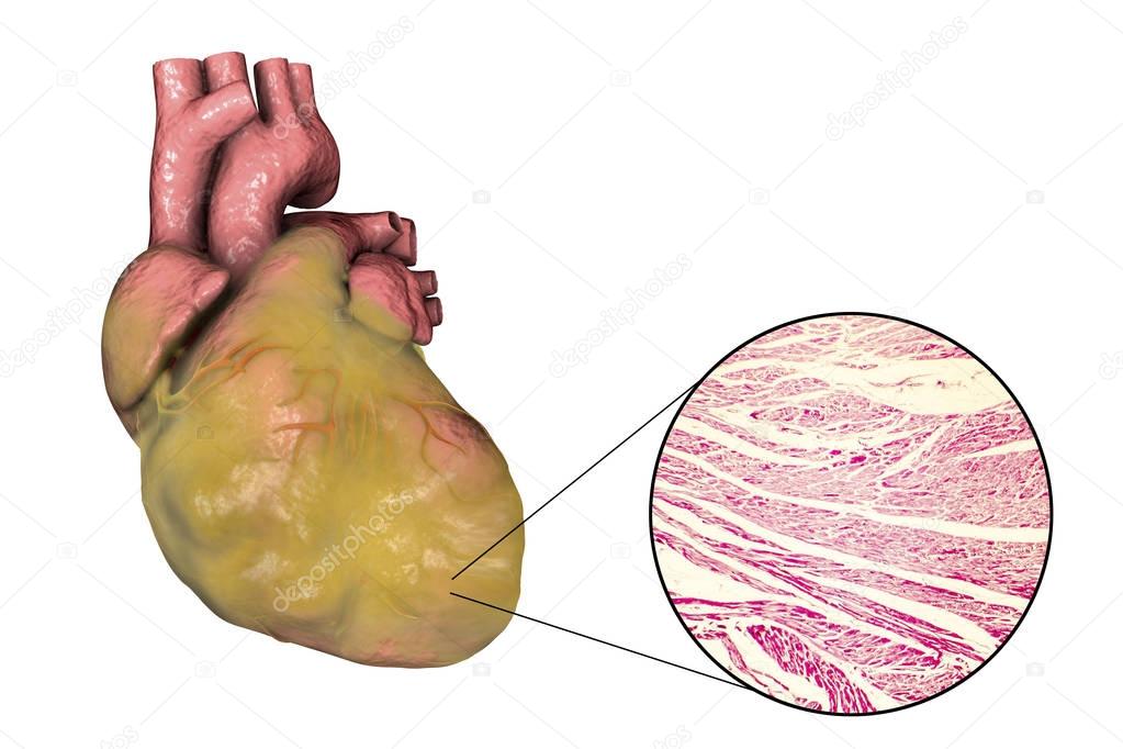 Obese heart, illustration