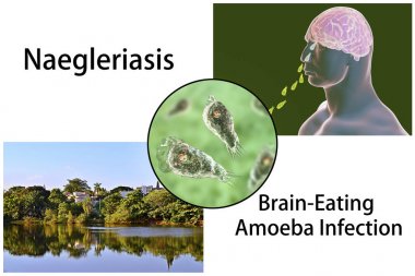 Brain-eating amoeba infection, naegleriasis clipart