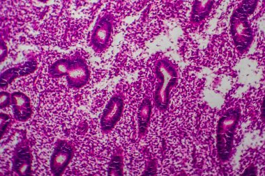 Endometriyal hiperplazma, ışık mikrografı, mikroskop altında fotoğraf.