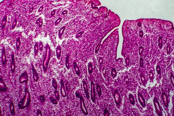 Hiperplasia Endometrial Micrografía Ligera Foto Bajo Microscopio —  Fotos de Stock