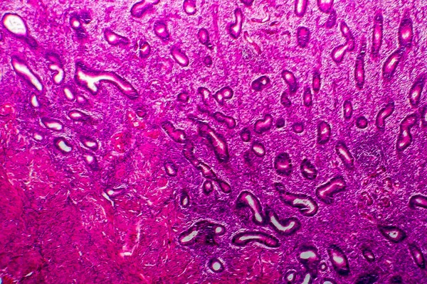 Hiperplasia Endometrial Micrografía Ligera Foto Bajo Microscopio — Foto de Stock