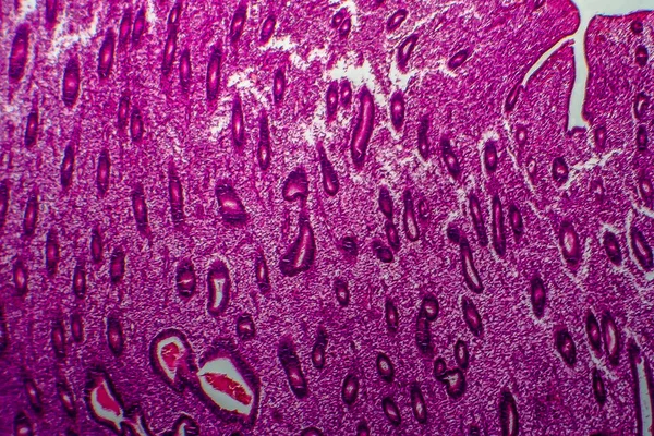 Endometrial Hyperplasia Light Micrograph Photo Microscope — Stock Photo, Image