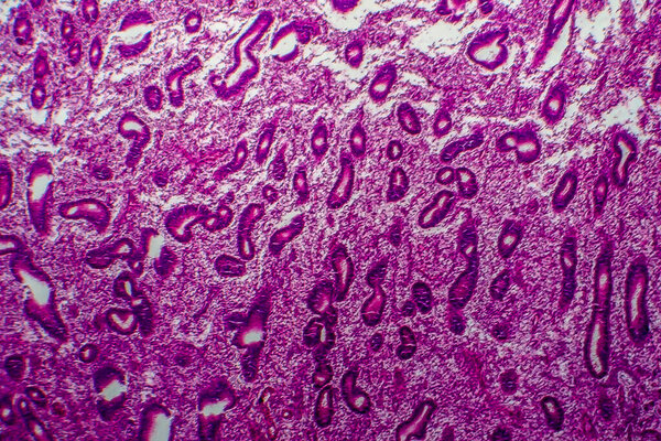 Endometrial hyperplasia, light micrograph, photo under microscope
