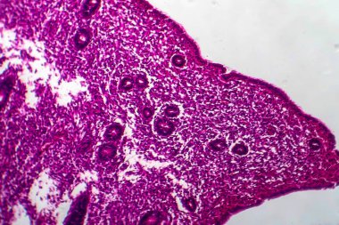Endometrial hyperplasia, light micrograph, photo under microscope clipart