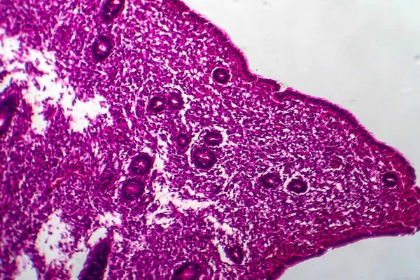 Ендометріальна Гіперплазія Легкий Мікрограф Фото Під Мікроскопом — стокове фото