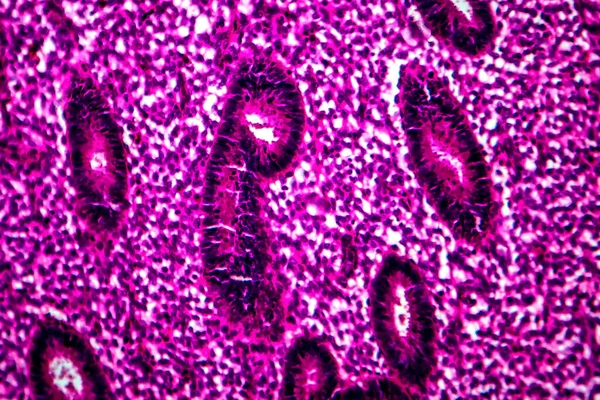 Hiperplasia Endometrial Micrografia Luz Foto Microscópio — Fotografia de Stock