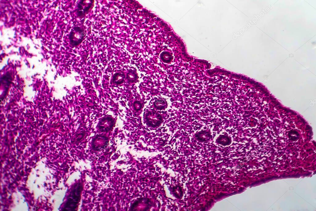 Endometrial hyperplasia, light micrograph, photo under microscope