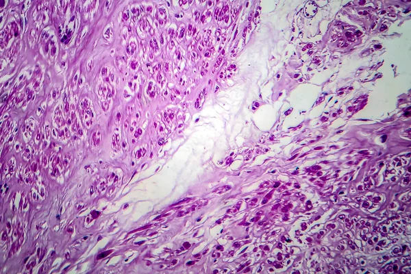 子宮筋腫 子宮の良性平滑筋腫瘍 ライトマイクログラフ 顕微鏡下での写真としても知られている子宮筋腫 — ストック写真