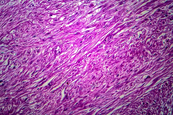 Uterine leiomyoma, also known as fibroids,a benign smooth muscle tumor of the uterus, light micrograph, photo under microscope