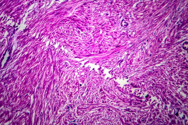 Uterine leiomyoma, also known as fibroids,a benign smooth muscle tumor of the uterus, light micrograph, photo under microscope