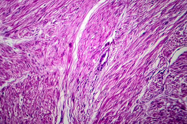 Uterine leiomyoma, also known as fibroids,a benign smooth muscle tumor of the uterus, light micrograph, photo under microscope