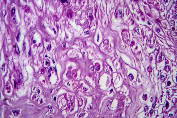 Gebärmutterleiomyom Auch Myome Genannt Ein Gutartiger Tumor Der Glatten Muskulatur — Stockfoto
