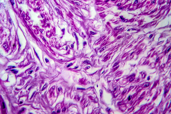 Uterine leiomyoma, also known as fibroids,a benign smooth muscle tumor of the uterus, light micrograph, photo under microscope