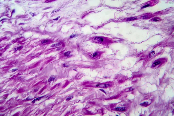 子宫肌瘤 又称纤维瘤 子宫平滑肌良性肿瘤 光镜下摄影 — 图库照片