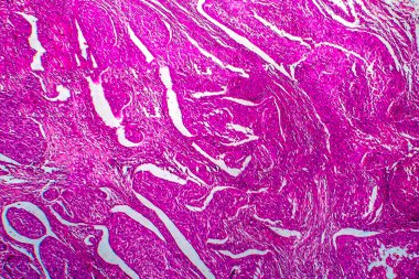 Rahmin skuamöz hücre kanseri, hafif mikrograf, mikroskop altında fotoğraf.