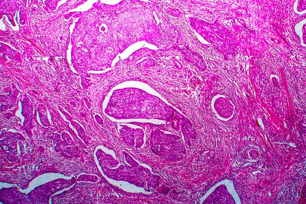 Dlaždicobuněčný karcinom dělohy, světelný mikrograf — Stock fotografie