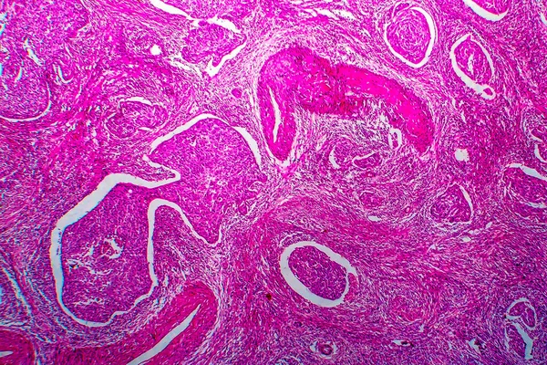 Carcinoma de células escamosas del útero, micrografía ligera — Foto de Stock