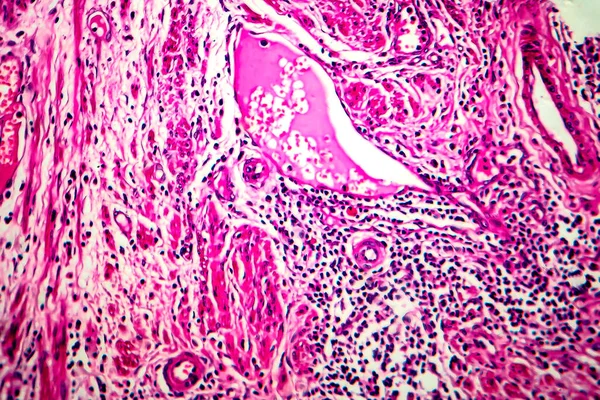 子宫鳞状细胞癌，光镜检查 — 图库照片