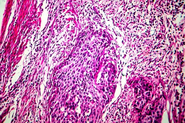 Squamous cell carcinoma of the uterus, light micrograph