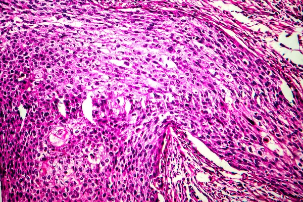 Відома клітинна карцинома матки, легкий мікрограф — стокове фото