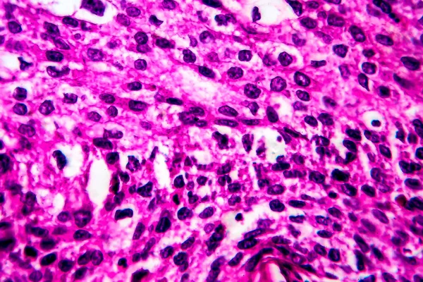 Dlaždicobuněčný karcinom dělohy, světelný mikrograf — Stock fotografie