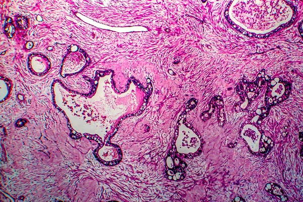 Рак матки, световой микрограф — стоковое фото