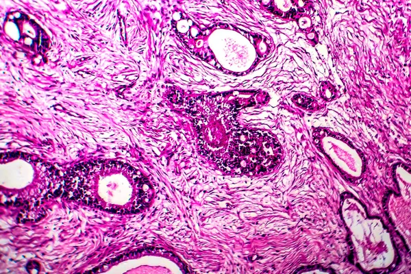 Cancro uterino, micrografia de luz — Fotografia de Stock