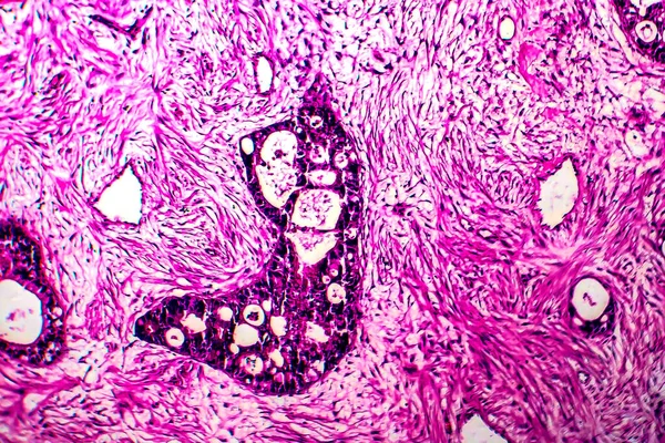 Cancro uterino, micrografia de luz — Fotografia de Stock