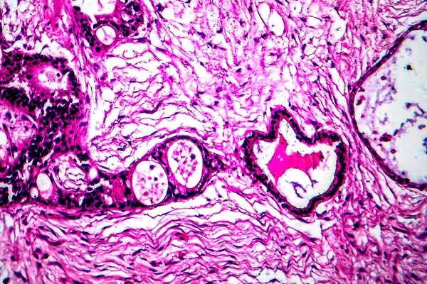 Rakovina dělohy, lehký mikrograf — Stock fotografie