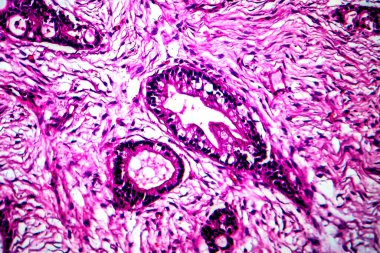 Rahim kanseri, hafif mikrograf.