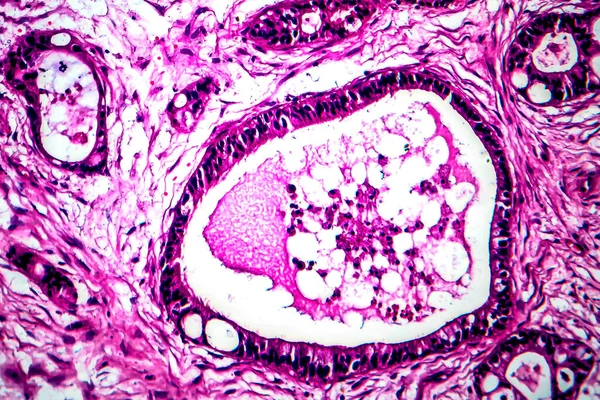 Rak macicy, mikrograf światła — Zdjęcie stockowe