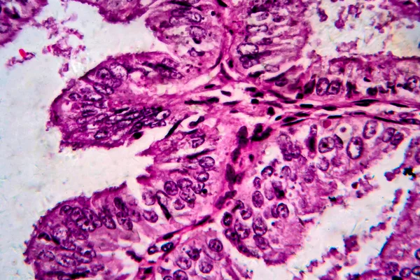 Gruczolakorak endometrium, mikrograf światła — Zdjęcie stockowe